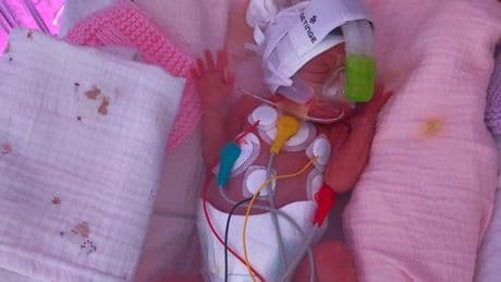 Premature baby with hands the size of fingertips born on mum's neonatal ward