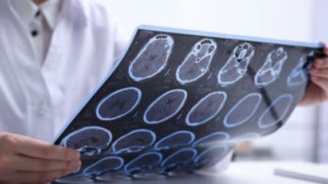 Sclerosi multipla per 144mila italiani, 10% è fuori da percorsi cura e assistenza