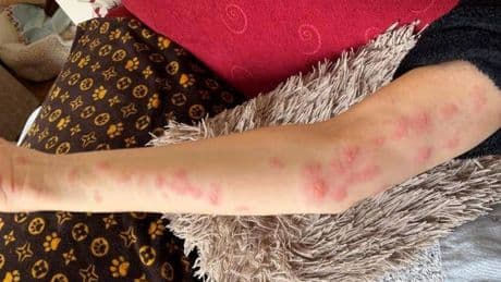 Woman's urgent warning after picking blackberries left her with horrific burns