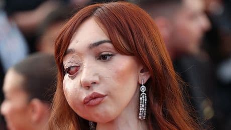 Veel lof voor influencer (21) met zeldzame aandoening op rode loper in Cannes