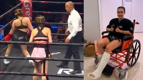 Así es la fractura del quinto metatarsiano que sufre Roro tras su combate de boxeo: 15 días de inmovilización