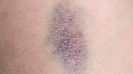 Große blaue Flecken? Dahinter kann eine Erkrankung stecken