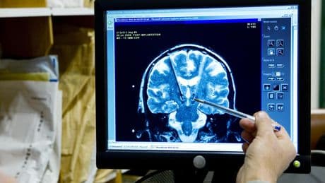 ¿Pueden los estimuladores cerebrales domésticos hacernos sentir mejor?