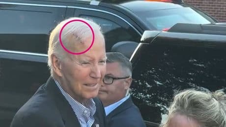 Ex-US-Präsident Joe Biden mit auffälliger Narbe nach Krebs-OP