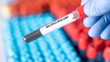 Mieloma multiplo, in Italia disponibile nuovo trattamento
