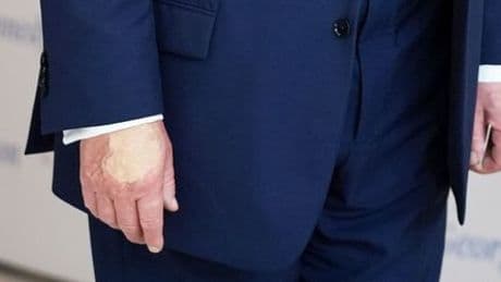 Donald Trump: Weißes Haus dementiert Gerüchte wegen Hand-Verfärbung