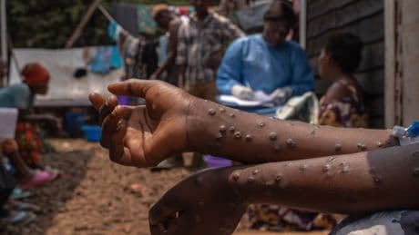 How Mpox revealed an epidemic of untreated HIV in Sierra Leone – as Trump’s aid cuts begin to bite