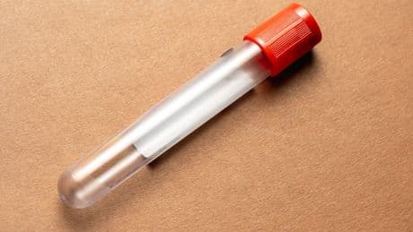 Simple blood test could accurately detect ovarian cancer in its early stages