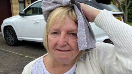 Woman viciously attacked by swooping seagull has to have scalp glued back together
