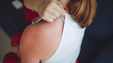 La dermatóloga Leire Barrutia avisa sobre las quemaduras: "Pueden irritar la piel dañada"