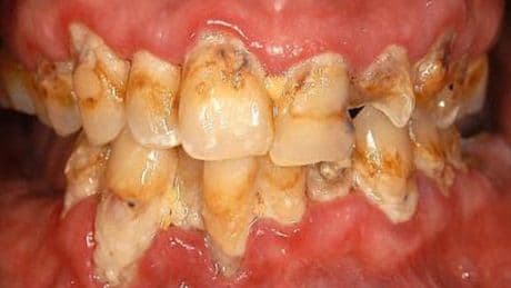 These vegetables have a natural compound that could lead to new plaque-destroying toothpastes