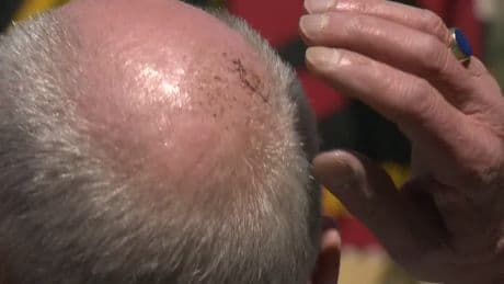 70-year-old victim of random Vancouver assault says attacker ‘body slammed’ him