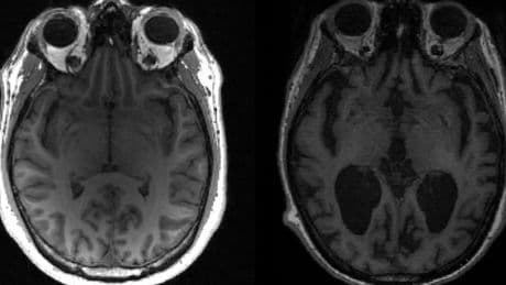 Comment un « miniprion synthétique » permet de mieux comprendre certaines maladies neurodégénératives