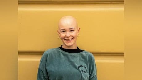 Anjoula verlor plötzlich alle Haare: „Diagnose war ein Schock“