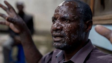 M çiçeği salgınında korkutan artış: Sierra Leone'de virüs patladı