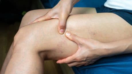 Krampfadern vorbeugen: So bleiben Ihre Venen gesund