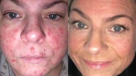 Non-greasy SPF that's 'anti-blemish' gives sun worshippers clearer skin and 'more confidence'