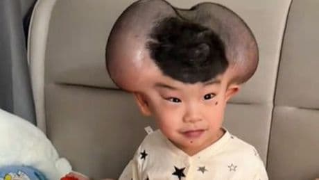 Boy makes wild transformation after rare condition earned him 'Mickey Mouse' nickname