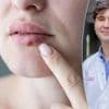 Tot 7 op 10 Belgen zijn besmet met herpes: wat kan je ertegen doen? “In de lente kan je hier meer last van hebben”