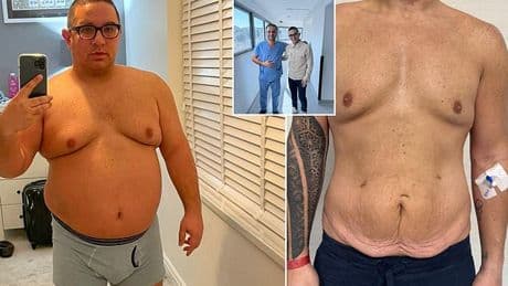 Massive NINE-stone weight loss left me with loose, saggy skin... now I've been transformed by brutal surgery which involved 'sawing the body in half'