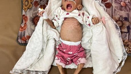 La hambruna en Gaza se agrava con 10 niños muertos más y extiende la indignación contra Israel
