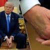 Lijfarts verklaart Trumps gezwollen benen en blauwe plekken: president heeft onschuldige aandoening aan aders