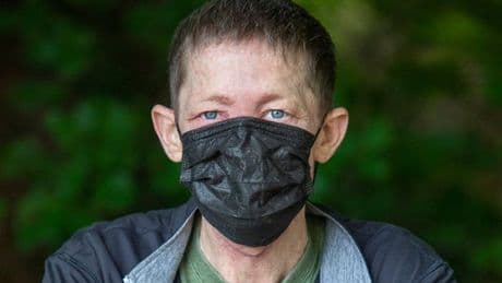 'Doctors gave me antibiotics because it hurt to breathe - now I have no nose'