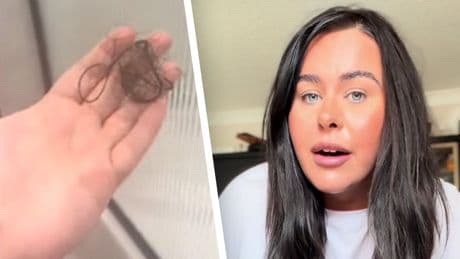 Kelsey nimmt die Abnehmspritze - „Ich habe 55 Kilo, aber auch büschelweise Haare verloren“