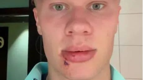 Gezicht Erling Haaland voor altijd getekend na botsing met deur Noorse teambus?