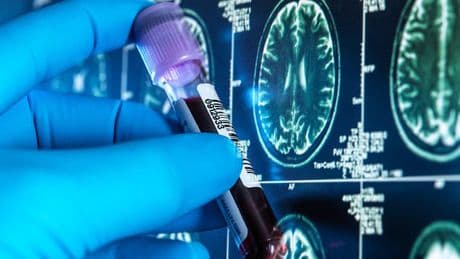 Thousands of Britons to receive cheap blood tests for Alzheimer's in landmark trial