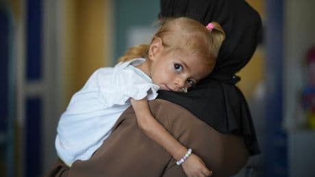 Toddler evacuated from Gaza with rare disease recovers from malnutrition in Italian hospital