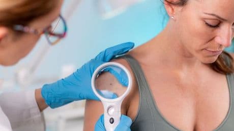'15-minute skin cancer check at Boots could've saved my life - and only cost £40'