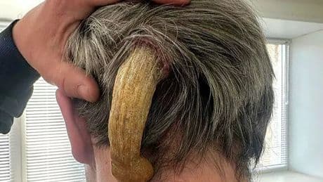 Man lives with painful 'enormous five-inch devil's horn' growing out his head