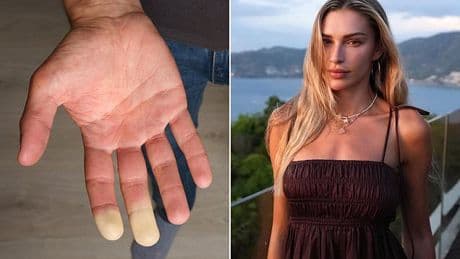 Doctors discover new potential treatment for condition that leaves sufferers' hands painfully cold