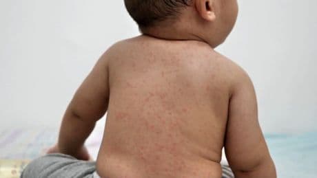 Measles cases show signs of exponential growth in western Canada, say health experts