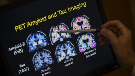The new blood test for Alzheimer’s scientists hope may soon be on the NHS