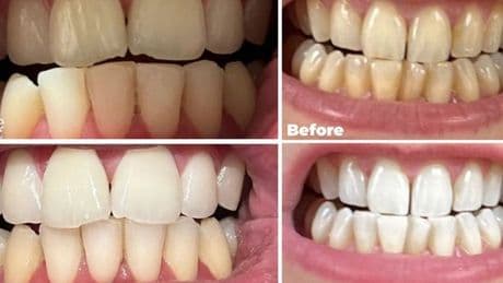 Dentist-backed 95p teeth whitening strips shoppers keep saying they'll 'buy again'