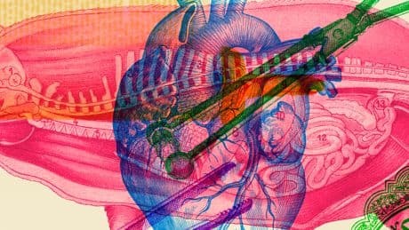 Pig Organ Transplants May Pose a Dilemma for Some Jews and Muslims