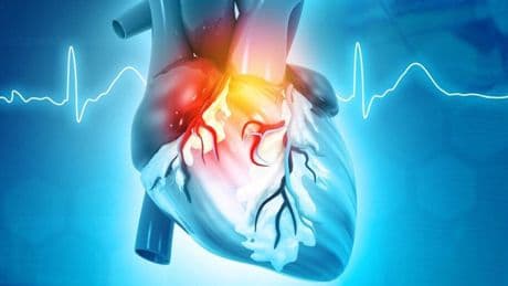 Fuoco di S.Antonio, infarto e ictus: un legame pericoloso