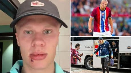 Erling Haaland left needing STITCHES after freak accident with Norway's team bus - as Man City star jokes about injury with fans