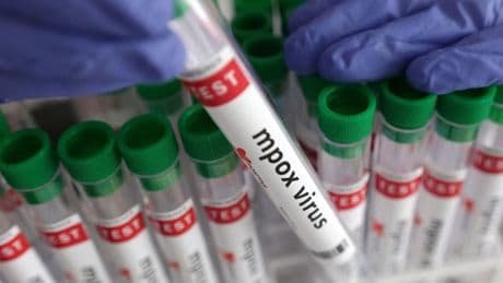 Europa registra 289 casos de mpox en 18 países durante el último mes