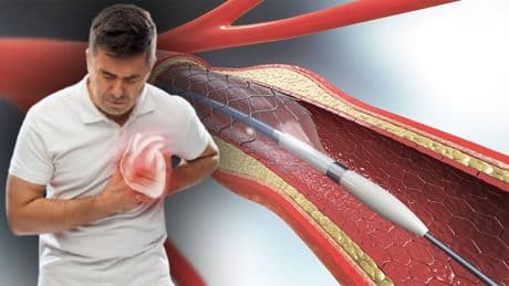 Uzmanlar uyardı: Stent korkusu hayatınıza mal olabilir!