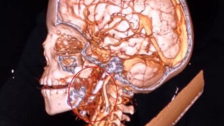 Boy, 7, has three-inch nail removed from his brain after horror accident