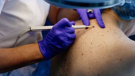 Major skin cancer vaccine change unveiled as NHS fast-tracks groundbreaking trials