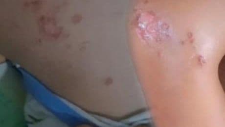 Serinlemek için girdi, yanıkla çıktı! Denizde enfeksiyon paniği: 'Buradan vücuda giriyor'