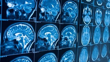 MS could start up to 15 years earlier than thought, new UBC research suggests