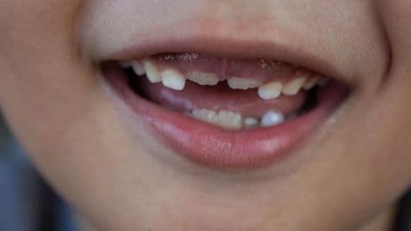 FDA moves to ban fluoride supplements for kids, removing a key tool for dentists