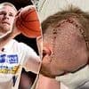 Aussie basketball star performs amazing feat after being told he'd never play again after a coward punch shattered his skull