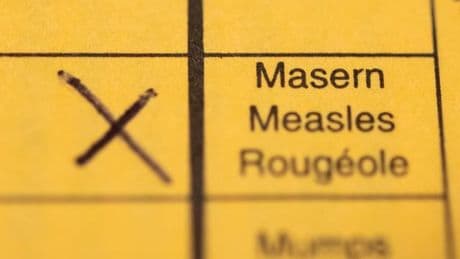Lebensgefährliche Krankheit: Masernfälle heuer bislang rückläufig - Impfquoten zu niedrig