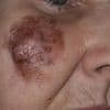 I had my entire cheek removed after a sunspot turned deadly – now I can’t look at myself or leave the house